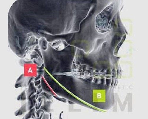 张笑天改脸型价格9.1W元起含杂费，上下联合打造精致小V脸,风格自然高级