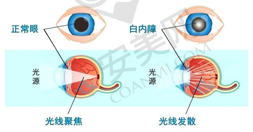 白内障与正常眼睛的区别