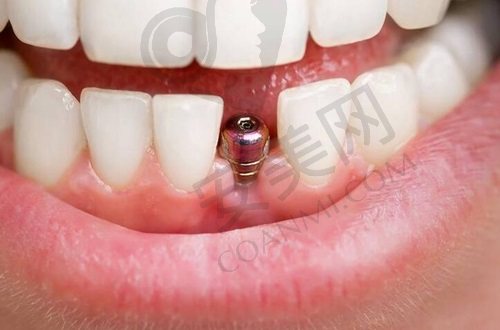 深圳格伦菲尔口腔医院种一颗牙要多少钱？