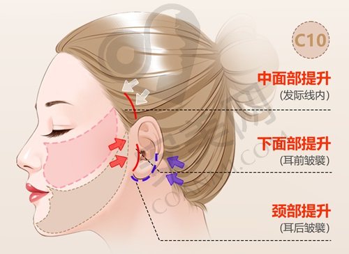 黄寺杜太超小拉皮提升价格