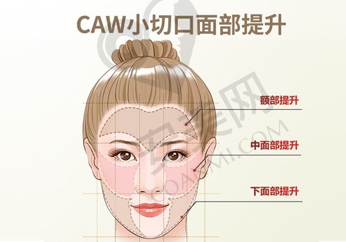黄寺杜太超小拉皮提升价格