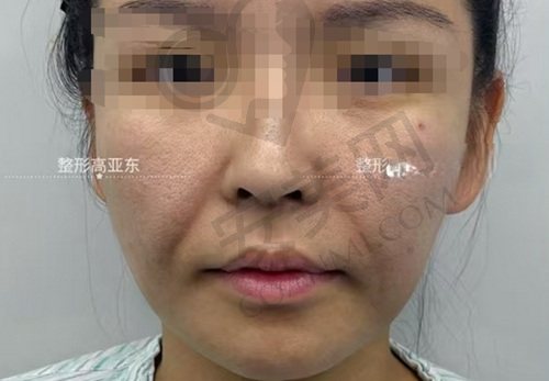 北京高亚东拉皮手术怎么样？
