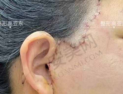 北京高亚东拉皮手术怎么样？