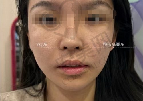 北京高亚东拉皮手术怎么样？