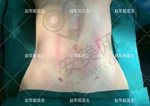 北京奥尔贝德赵军舰医生吸脂价格