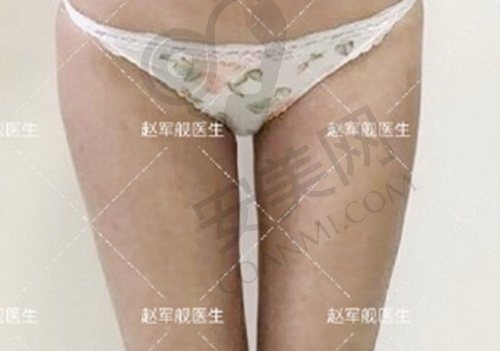 北京奥尔贝德赵军舰医生吸脂价格
