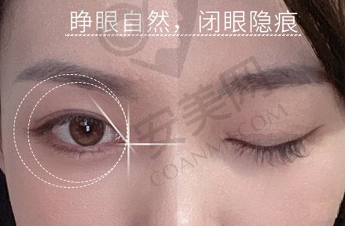 北京丰联丽格师丽丽双眼皮修复技术好吗？