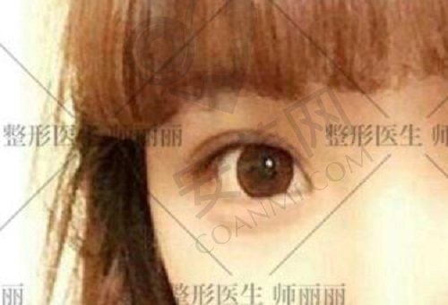 北京师丽丽双眼皮修复技术好吗？