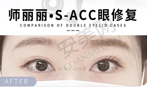 北京师丽丽双眼皮修复技术好吗？