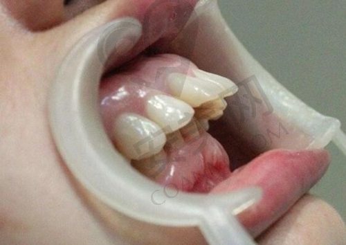 深圳慈恩齿科陈江山牙齿矫正怎么样？