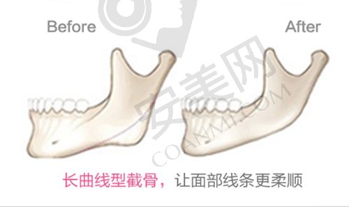 上海华美李志海做下颌角怎么样？