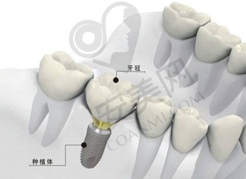 西安中诺口腔瞿磊医生种植牙怎么样？
