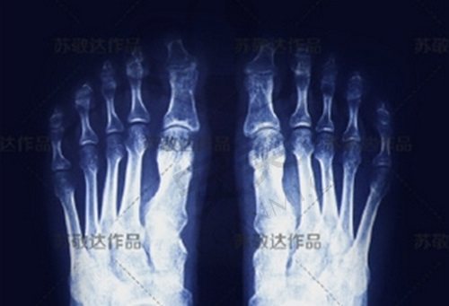 苏敬达医生做大脚骨手术技术水平怎么样？