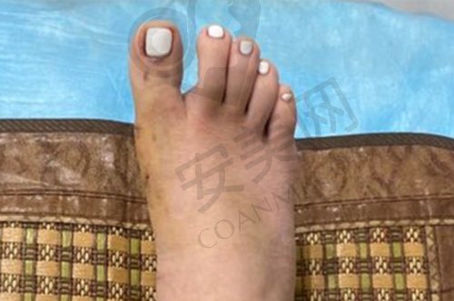 北京圣嘉新苏敬达医生大脚骨手术费用
