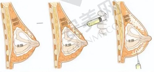 项力源丰胸价格是53000元起