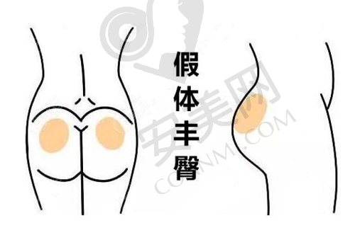 深圳福雅胡俊杰医生假体丰臀