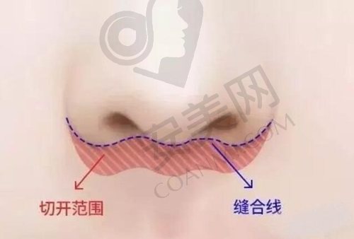 深圳福雅胡俊杰擅长人中缩短术