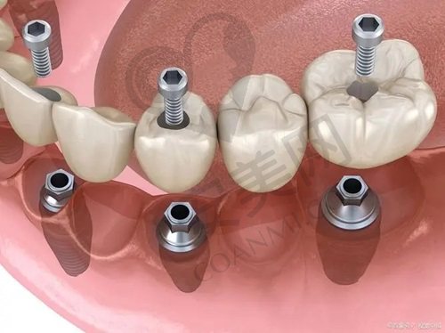 北京牙元素口腔刘可新医生种植牙技术怎么样？