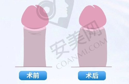 阴茎增粗.jpg