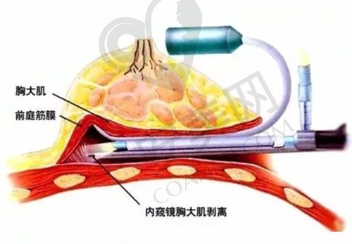 重庆星荣刘正茂医生隆胸怎么样？