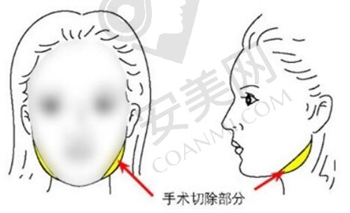 重庆星荣刘正茂磨骨怎么样？