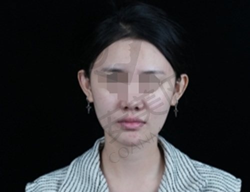 亲历成都素美李建刚筋膜提升
