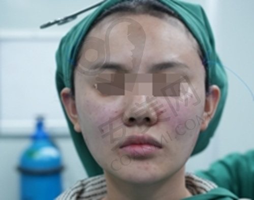 亲历成都素美李建刚筋膜提升
