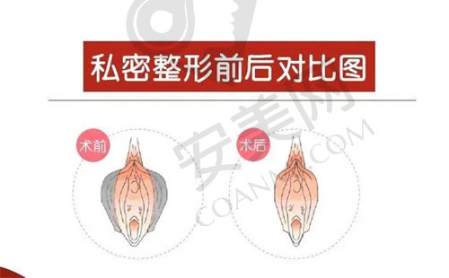 南京美贝尔医院私密整形手术做的好吗？