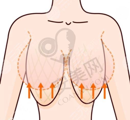 乳房缩小提升