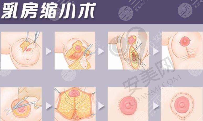 乳房缩小提升