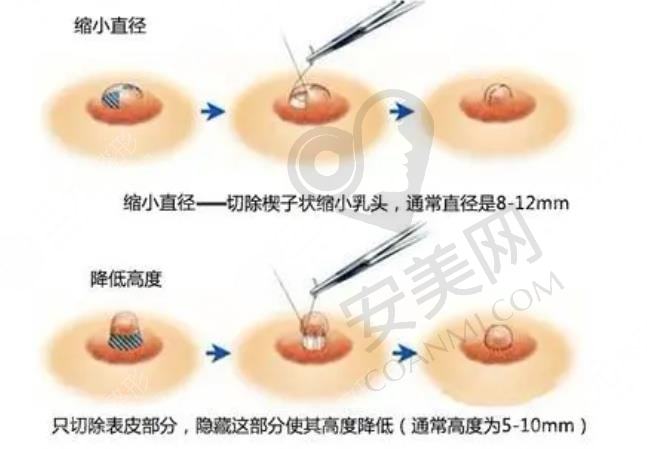 乳房缩小提升