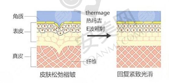 热玛吉是什么原理