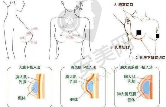 英国娜高假体的优势性