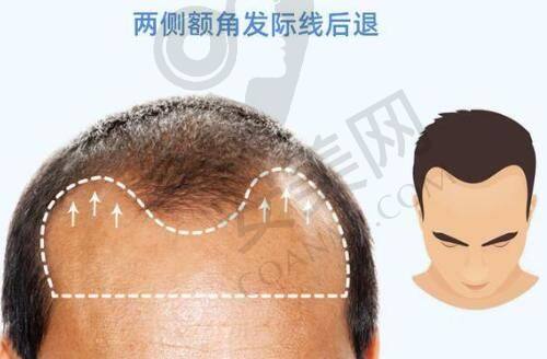 邯郸京美医院的双下巴吸脂技术有什么特色？