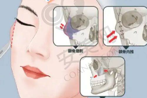 双下巴吸脂的成效能维持多久？