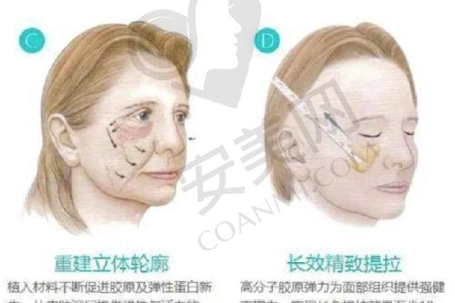 4800/5000毛囊单位植发套餐：重度脱发的终极解决方案