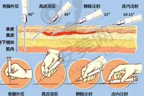 耳再造整形手术过程是怎样的？