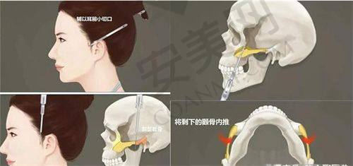 如何预约广州艺星腰腹吸脂手术？