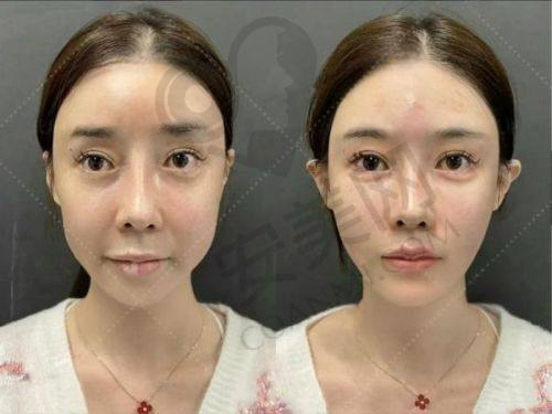 哪些人适合北京禾美嘉面部脂肪填充？