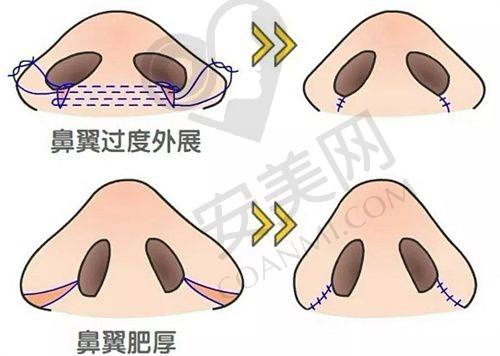1500毛囊单位植发套餐：局部改善的性价比之选