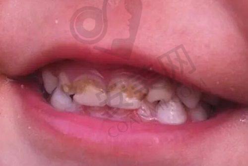 徐州美奥口腔门牙修复680元起是真的吗？