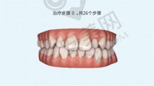 时代天使隐形矫正的价格为何是16000元起？