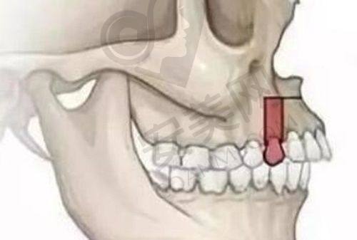 美加牙贴面的适用人群有哪些？