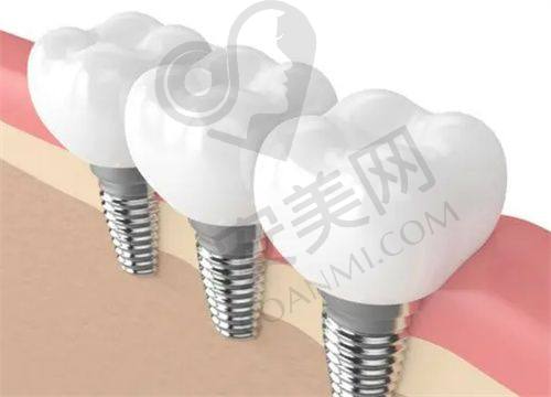 爱尔创全瓷冠在南京溧水瑞齿固德口腔的价格分阶情况是怎样的？