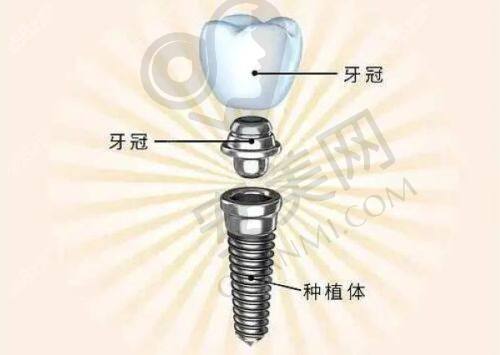 太原皓雅口腔全瓷牙冠修复技术有哪些特色？