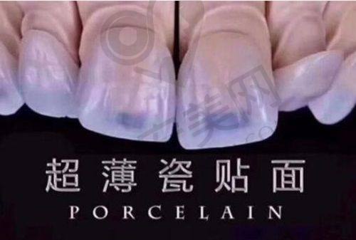 影响清华阳光矫正牙齿收费的因素