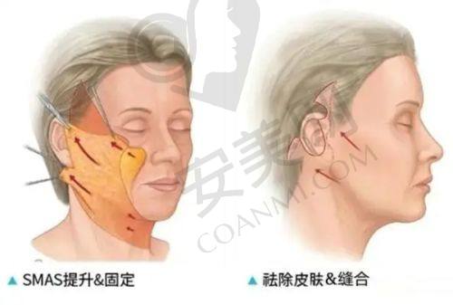 广州雪儿海蒂私密李宁辉医生诊疗技术优势