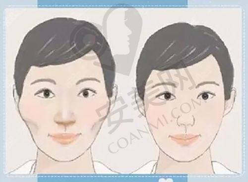 北京禾美嘉面部脂肪填充的修复过程是怎样的？