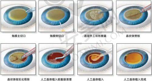 辽宁曙光医院双眼皮修复技术有何独特之处？