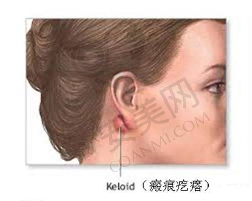 微针美塑：促进疤痕淡化的有效方法